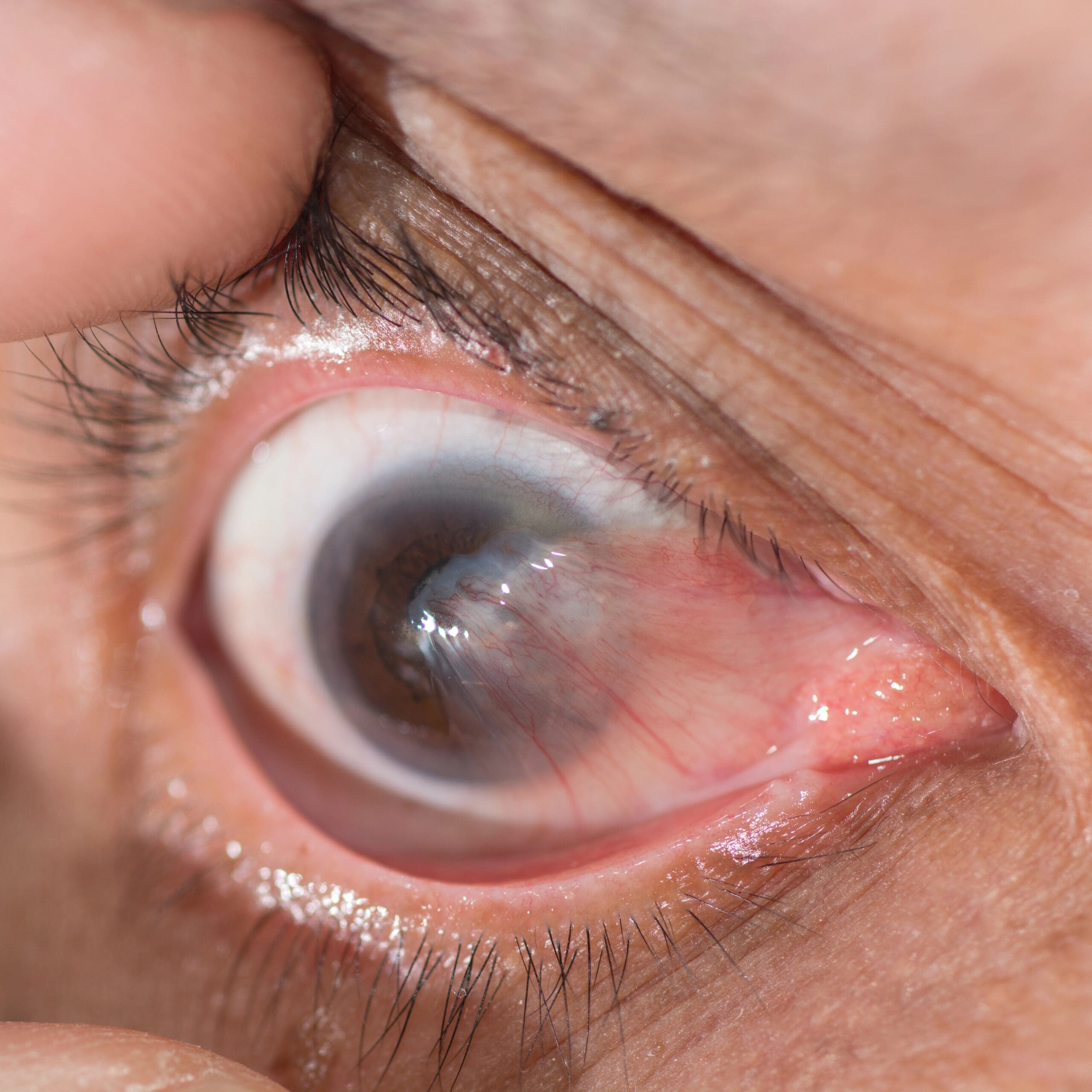 pterygium of the eye