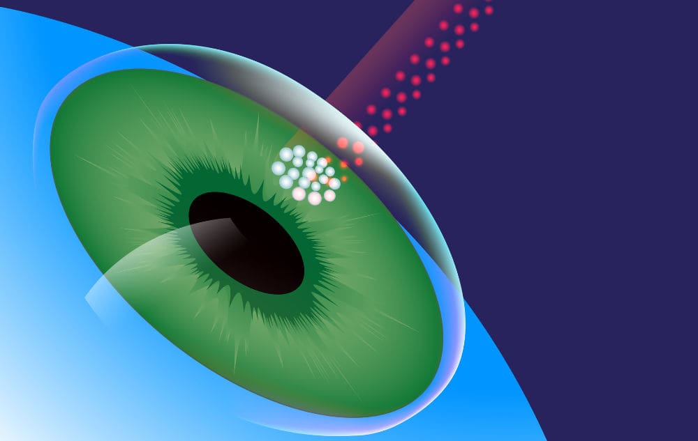 A illustration of LASIK eye surgery showing the lens of the eye and a laser. 